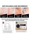 Salicylic Acid Acne Soap Deep Cleansing Pore Unclogging Vibrant Glamour 100g
