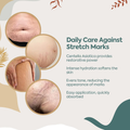 Classy Stretch Mark Cream for Moisturizing and Improving Skin Elasticity, 100g