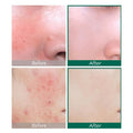 Some By Mi AHA BHA PHA 30 Days Miracle Serum with Tea Tree & Centella - 50ml