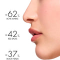 Face Moisturizer Acne Control Salicylic Acid Vichy Normaderm 50ml