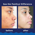 Benzoyl Peroxide Foaming Cleanser Acne Wash 10% Panoxyl 156g