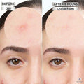 Garnier Invisible Hydrocolloid Patches for Pimple Treatment - 22 Count (10mm & 12mm)