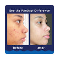 PanOxyl Acne Foaming Wash 10% Benzoyl Peroxide