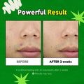 Troubless Clear Gel Cream Blemish-Clearing Tea Tree 4-Terpineol 15ml