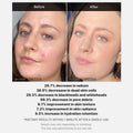 Medicube Red Blemish-Clearing Succinic Acid Peel Cream for Oily Skin