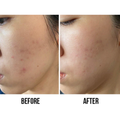 La Roche-Posay Effaclar Serum with Salicylic Acid for Pore Cleansing and Acne Treatment, 30ml