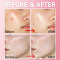 Spot Healing Gel Salicylic Acid Acne Treatment Purederm 20ml